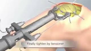 Comminuted Patellar Fracture [upl. by Cleaves]