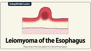 Leiomyoma of the Esophagus [upl. by Voleta186]