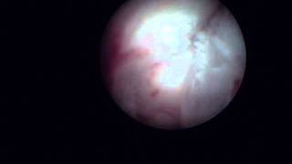 Arthroscopy of the Jaw Temporomandibular Joint TMJ  Part 1 [upl. by Edecrem843]