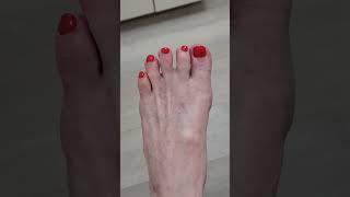 Bunion Surgery  Successful Bunionectomy [upl. by Udell]