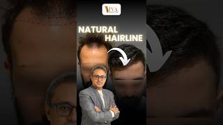 from Bald to Natural Hairline by Hair Transplant  Shocking results [upl. by Roer]