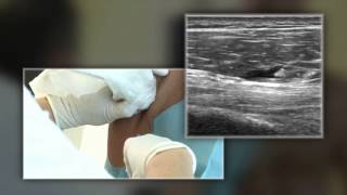 OSTENIL® Tendon injection 44 Biceps Brachii [upl. by Devon]