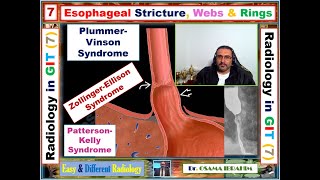 How to differentiate between sophageal stricture webs and rings 7 radiology in GIT [upl. by Gnilrad704]