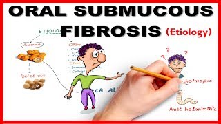 Oral Submucous Fibrosis OSMF Etiology [upl. by Bonn158]