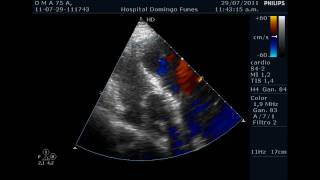 Protesis Valvular Aortica Mecanica 12 Anos despues Dr Pedro Guillermo Bustos Julio 2011wmv [upl. by O'Malley]