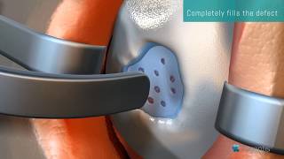 GelrinC Implant  Narrated MOA Animation  Articular Cartilage Repair  Regentis Biomaterials [upl. by Clim211]