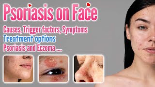 Psoriasis on Face Causes Symptoms Trigger Factors Types Contagiosity and treatment options [upl. by Esoryram]