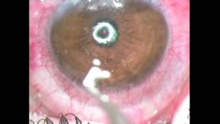 Intracorneal ring implantation  Supplementary video 26118 [upl. by Newnorb566]