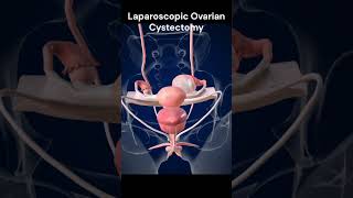 Laparoscopic Ovarian Cystectomy [upl. by Assennej]