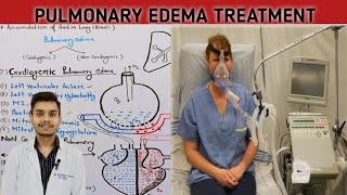 Pulmonary edema diagnosis treatment in Hindi  pulmonary edema treatment [upl. by Farrow]