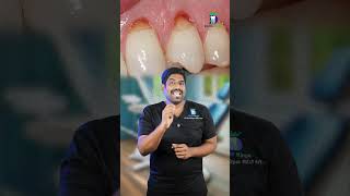 பல் சுத்தம் செய்தால் கூசுமா Sensitivity during dental scaling  DrKarthikeyan  Denta Kings [upl. by Attiuqihc235]