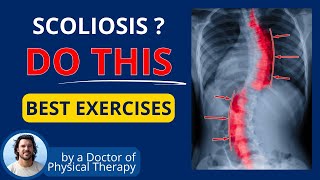 10 NEW Exercises for Scoliosis Relief [upl. by Ihsakat]