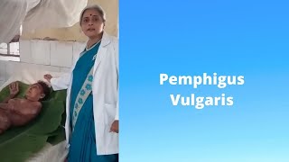 PEMPHIGUS VULGARIS Marathi pemphigus vulgaris treatment DR SMITA CHAKOTE [upl. by Artenak811]