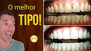 QUAL CLAREAMENTO DENTAL É MELHOR LASER ou CASEIRO [upl. by Desmond]