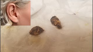 Does EARWAX Alone Cause Temporary Complete HEARING Loss Ear Wax Removal Cant Hear Crackling Cerumen [upl. by Naitsirhk]