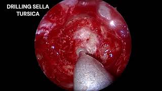 Endoscopic Transsphenoidal Hypophysectomy for Pituitary MacroadenomaDr Babu ARJSS AHER Mysore [upl. by Hamachi748]