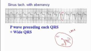 ECG Sinus Rhythm with Aberrancy [upl. by Cotsen897]