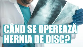 Când se operează hernia de disc și când nu este necesară operația [upl. by Nylarac]