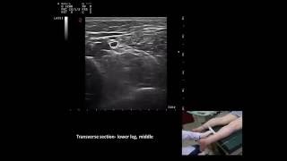 Ultrasound guided m tibialis posterior botulinum toxin injection by Murat Karkucak MD [upl. by Bak564]