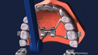 Advanced Orthodontics  Expanders [upl. by Melentha]