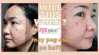 RYX Skincerity Clear Bomb burned my skin  SKINCARE REVIEW for ACNE [upl. by Arracot708]