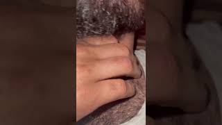 Ingrown hairs and hair loss clearly barbersurgion barber [upl. by Enelav]