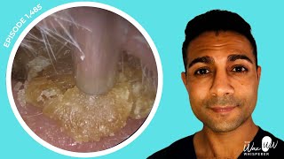 1485  Masses of Dead Skin Removed from Both Ears  Learn About Different Ear Wax Drops [upl. by Robyn]