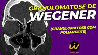 GRANULOMATOSE de WEGENER  Granulomatose com Poliangeíte [upl. by Vento460]