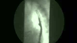 Video 8  Gastroesophageal reflux [upl. by Etom]