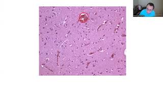 NEUROPATHOLOGY BOARD REVIEW 1 [upl. by Notac]