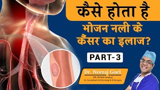 भोजन नली के कैंसर का इलाज  Treatment of Esophageal Cancer  Dr Neeraj Goel Part  3 [upl. by Haeluj]