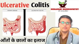 Ulcerative colitis symptomsdiettreatment  Ulcerative colitis homeopathy [upl. by Aneres]