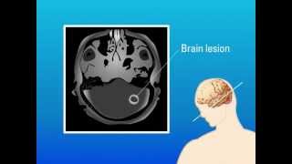 Extrapulmonary Aspergillosis – Type of Fungal Infection [upl. by Baer664]