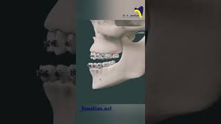 Le Fort I osteotomy for maxillary advancement dentistOsteotomy orthodontistMaxillaryAdvancement [upl. by Fantasia129]