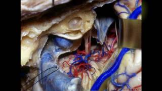 Navigating the Temporal Bone  Part 3 of 3 [upl. by Charmion]