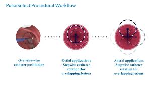 Pulsed Field Ablation PFA in Atrial Fibrillation [upl. by Salb]