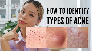 How to treat EVERY type of acne With Pictures [upl. by Ahsilet]