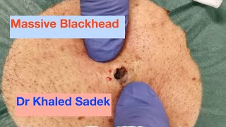 Large Blackhead removal Dr Khaled Sadek LipomaCystcom [upl. by Manvell916]