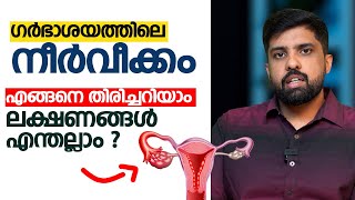 ഗർഭാശയത്തിൽ നീർവീക്കം ഉണ്ടോ  എങ്ങനെ തിരിച്ചറിയാം  ലക്ഷണങ്ങൾ എന്തല്ലാം [upl. by Temirf472]