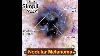 Nodular Melanoma Dermoscopy [upl. by Aztirak]