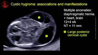 Cystic hydroma and nuchal edema at 1113 weeks of pregnancy [upl. by Kenton]