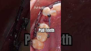 How to pull teeth when braces braces orthodontist dentist dental [upl. by Nnod]