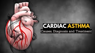 Cardiac Asthma Causes Signs and Symptoms Diagnosis and Treatment [upl. by Shalna]