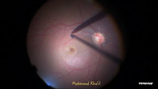 Unstained ILM peeling in macular hole amp PDR [upl. by Karlee]