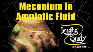 Meconium in Amniotic Fluid  Ultrasound  Case 314 [upl. by Bing770]