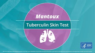 Mantoux Tuberculin Skin Test Video [upl. by Alarice]