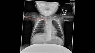 Peripherally Insert Central Venous Catheters PICCs  Pediatric Radiology and NICU [upl. by Aliakam]