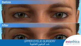 Blépharoplastie Paupière Supérieure [upl. by Matthieu]