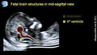 Normal fetal brain anatomy at 1113 weeks  2D scan [upl. by Neeloc]