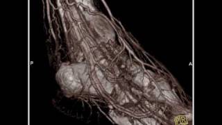 Vascular CT angiography of the lower extremity3 of 3 [upl. by Acinonrev851]